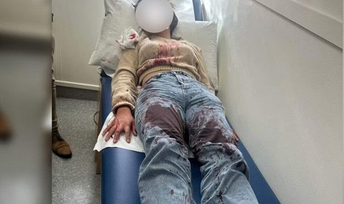 14세 소녀에게 무차별 폭행 당한 12세 소녀. [연합뉴스]